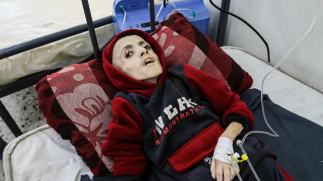 طفل يعاني سوء تغذية حاد