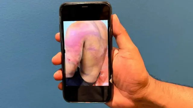 صورة لظهر رافي تُظهر أثر التعذيب على جسده