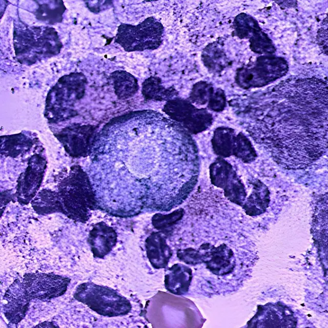 Naegleria fowleri is an amoeba (one-celled living organism) that lives in soil and warm freshwater, such as lakes, rivers, and hot springs. It is commonly called the brain-eating amoeba because it can cause brain infection when water containing the amoeba rises in the nose. Only about three people in the United States are infected each year, but these infections are usually fatal. (Photo by: CDC/IMAGE POINT FR/BSIP/Universal Images Group via Getty Images)