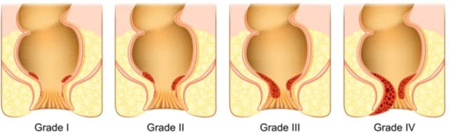 ਬਵਾਸੀਰ ਅਤੇ ਗੁਦਾ ਦੇ ਕੈਂਸਰ ਵਿੱਚ ਅੰਤਰ