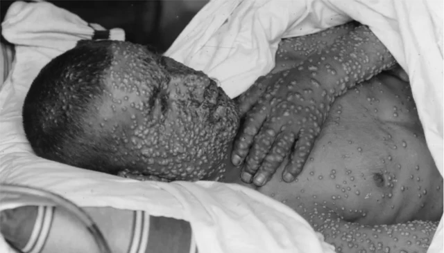 A boy with pustules over his face and body