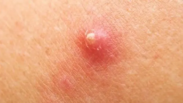 இதில் கரும்புள்ளிகள் (Blackheads), வெள்ளைப் புள்ளிகள் (Whiteheads), நீர்க்கட்டிகள் (Cysts) மற்றும் கட்டிகள் (Nodules) எனப் பல வகைகள் உள்ளன.
