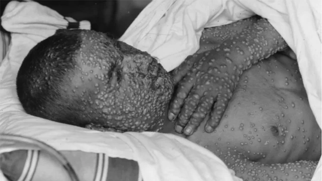 Seorang korban pengidap cacar yang wajah dan lengannya dipenuhi bintik-bintik.