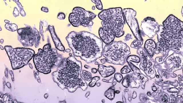 Virus Nipah In The Cerebrospinal Fluid Of An Infected Patient Tem, Recolorized Imagery