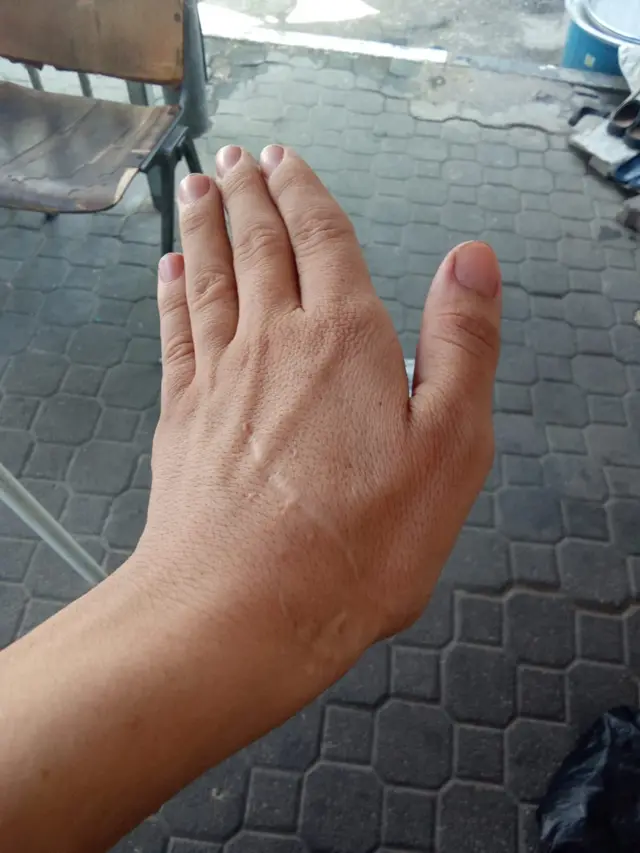 جرح بآلة حادة أثناء الحصول على المساعدات