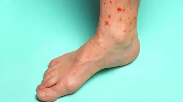 ছারপোকার কামড় একেক ব্যক্তির শরীরে একেক রকম প্রতিক্রিয়া তৈরি করে।