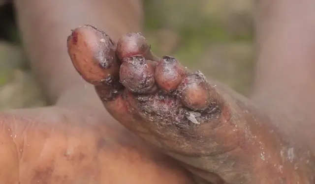 Amavunja ku kirenge cy'umwana i Musanze