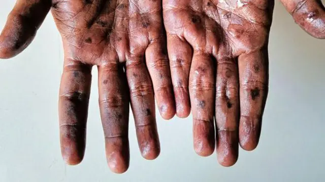 ஆப்பிரிக்க நாடுகளில் குரங்கம்மை பரவி வருகிறது