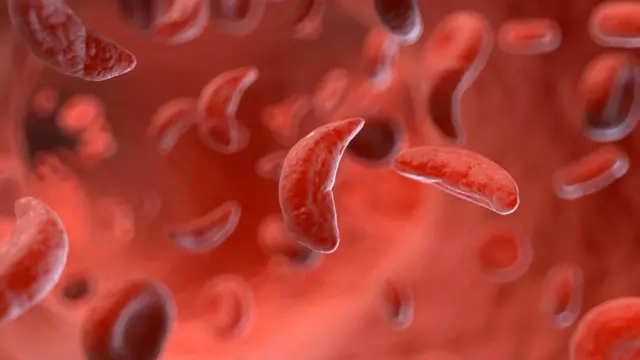 सिकलसेल 