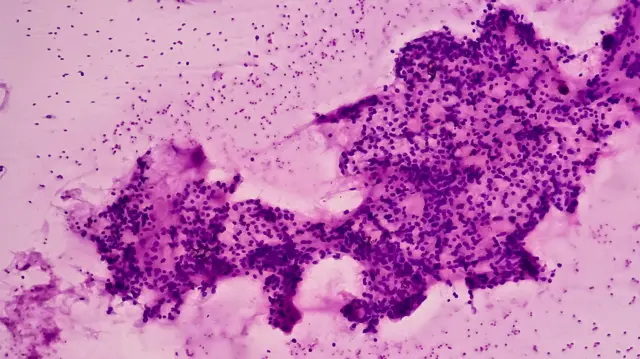 बैक्टीरियल वेजिनोसिस 