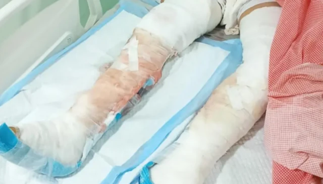 மனித சதையை உண்ணும் பாக்டீரியாவால் சிறுவன் காலை இழந்தானா?