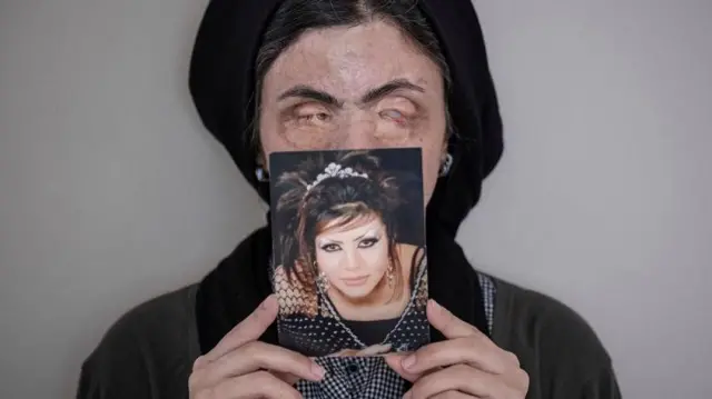 Masoumeh Ataei, yang menjadi korban serangan air keras di Provinsi Teheran memegang potretnya yang diambil sebelum serangan. 