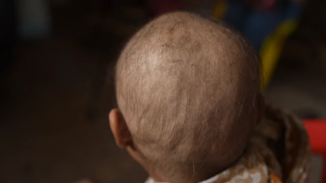 Kerontokan rambut di India