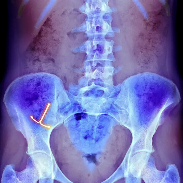 Una radiografía muestra un dispositivo anticonceptivo intrauterino en el vientre de una mujer