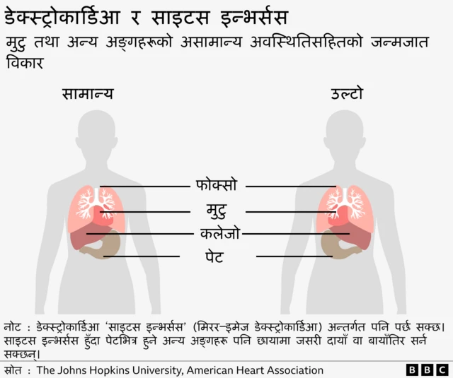 डेक्स्ट्रोकार्डिआ र साइटस इन्भर्सस