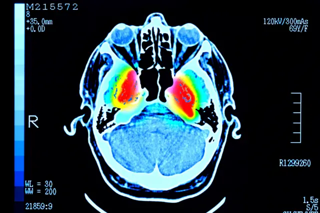 Imagem de um exame cerebral mostrando áreas vermelhas no centro, cercadas por regiões em amarelo, verde e azul-claro.