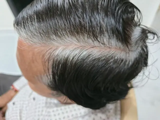 முடி உதிர்தல் பிரச்னை, கட்டுக்கதையும் உண்மையும்