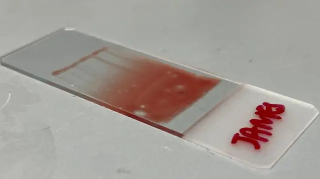 एक अतिशय पातळ थर करण्यासाठी सूक्ष्मदर्शकाच्या स्लाईडवर रक्त पसरवलं जातं