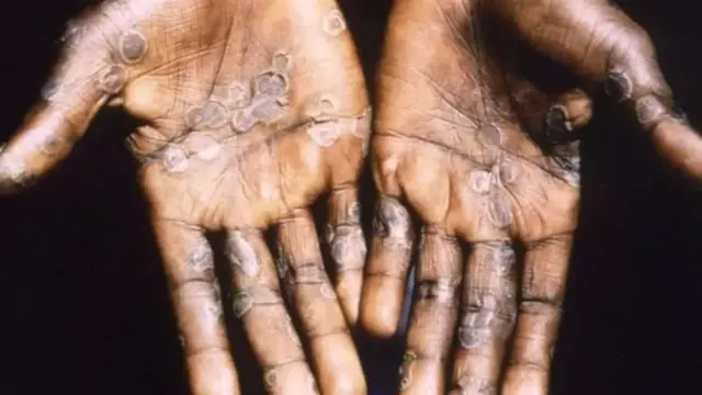 Seseorang yang terjangkit cacar monyet akan mengalami ruam. Ruam dimulai pada wajah, kemudian menyebar ke bagian tubuh lainnya, paling sering pada telapak tangan dan telapak kaki.