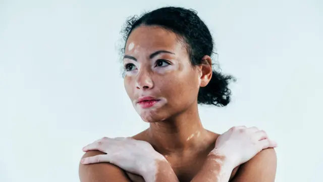 Una mujer con vitiligo