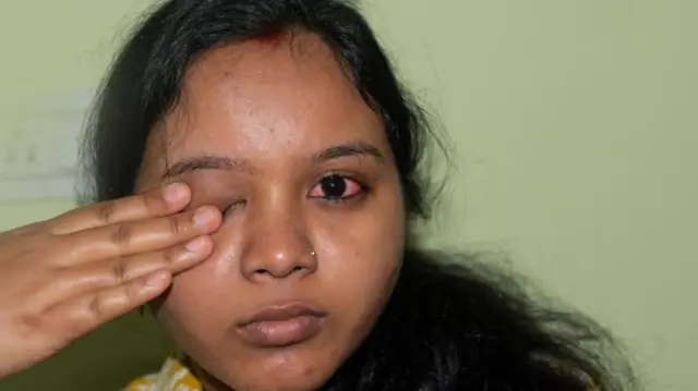 மெட்ராஸ் ஐ