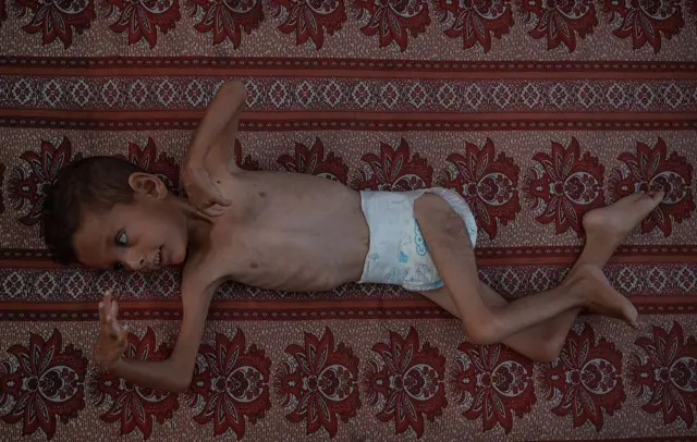 صورة لطفل مريض بشلل الأطفال يبلغ من العمر خمس سنوات، ينام على سجادة في مخيم للاجئين على طول مدينة غزة، وهو يكافح من أجل البقاء على قيد الحياة، بسبب معاناته من سوء التعذية. يظهر الطفل نحيلاً وجسده هزيل للغاية بينما تبرز العظام من داخل قفصه الصدري.