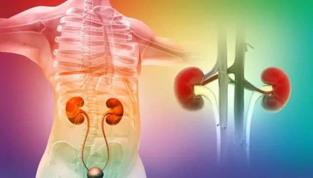 گردے کی پتھری