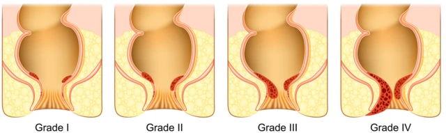 मूळव्याधाचे टप्पे