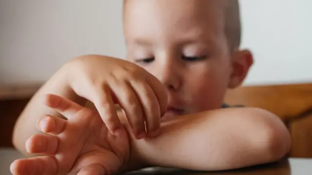 کودکی در حال خاراندن محل گزش پشه