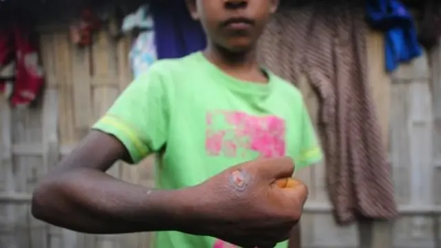 অ্যানথ্রাক্স আক্রান্ত একজন কিশোর (ফাইল ছবি)