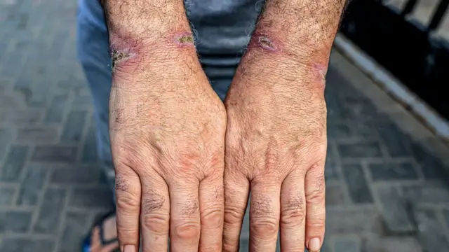 Namni hidhaa gadhiifamee Gaazaatti deebi'e, miidhaa irra gahe agarsiisa