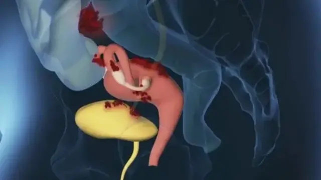 Foto of wetin dey cause period pain