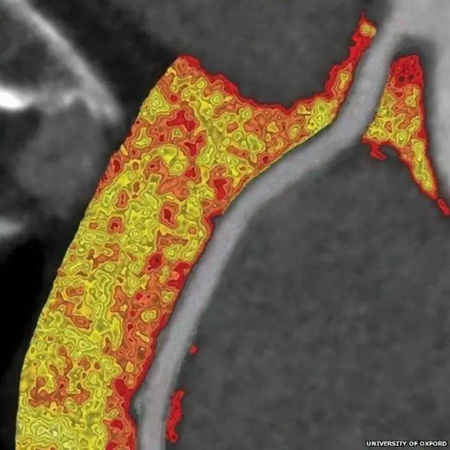 ਦਿਲ ਦੀ ਬੀਮਾਰੀ