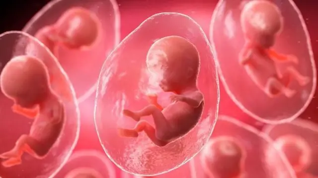 आइभीएफ प्रक्रियामा जुम्ल्याहा वा तीनवटा बच्चा जन्माउने सम्भावना हुन्छ