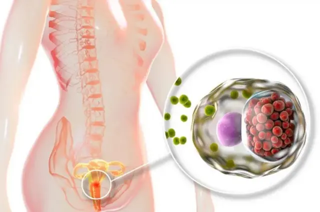 Mycoplasma genitalium ni ikibazo gikomeye ku ruhu rw'imyororokere ku bagore