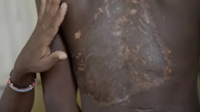  Kipigo cha Caleb kimemsababishia makovu mgongoni na miguuni