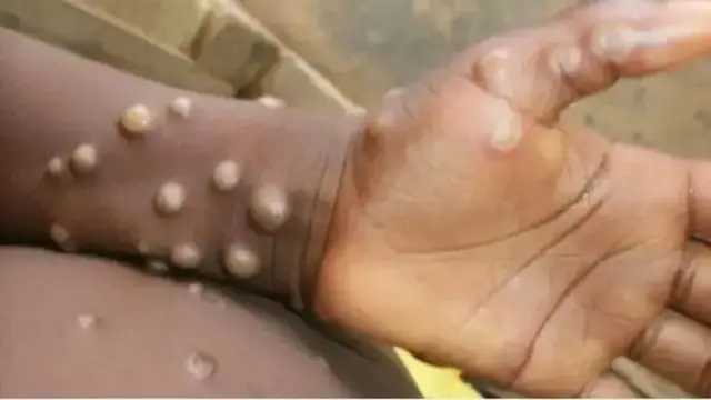 Onye na-arịa ọrịa Mpox