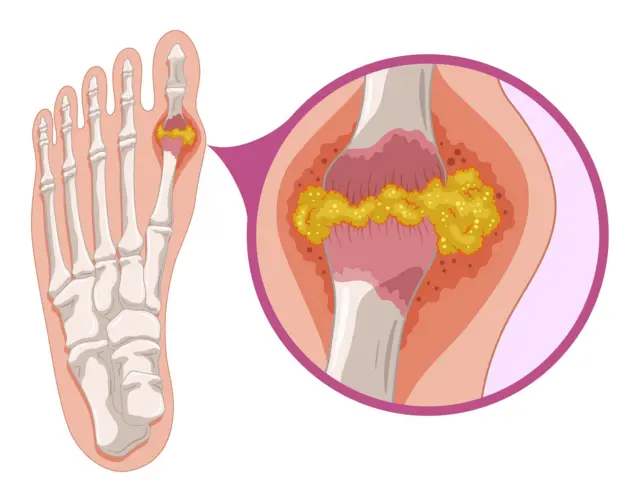 शरीरातील युरिक ॲसिड वाढल्यामुळे सांधेदुखी होते? हे आहेत उपाय