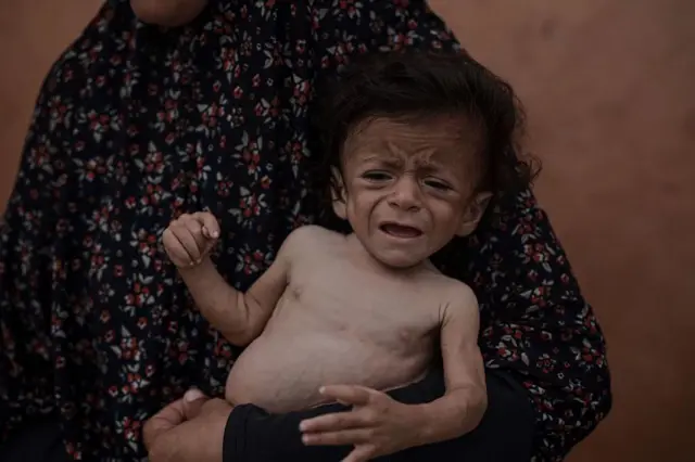 طفل من غزة يعاني نقص التغذية