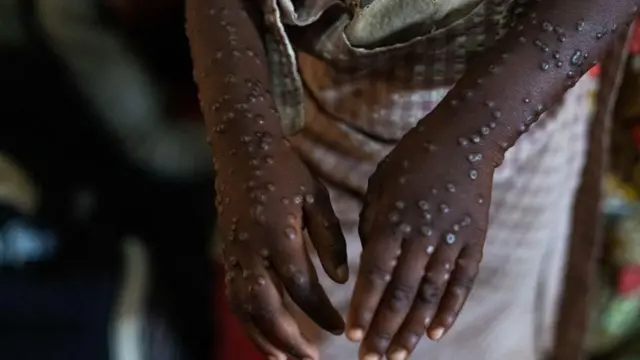 Graphic content / One patient wit severe form of di mpox epidemic dey collect treatment for di Kavumu hospital, 30 km north of Bukavu for eastern Democratic Republic of Congo