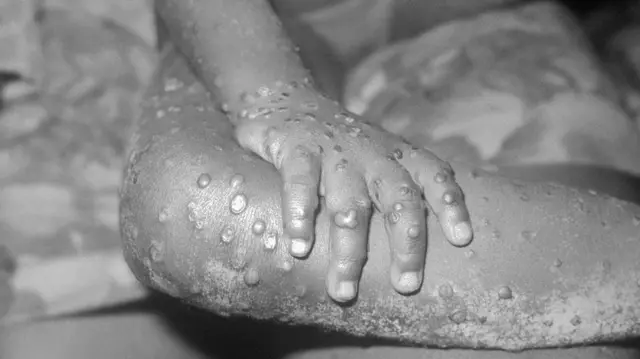 Маймыл чечеги илдети 1970-жылы катталган 