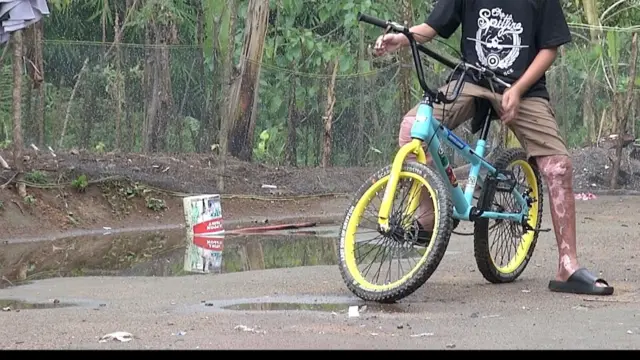 Luka bakar.