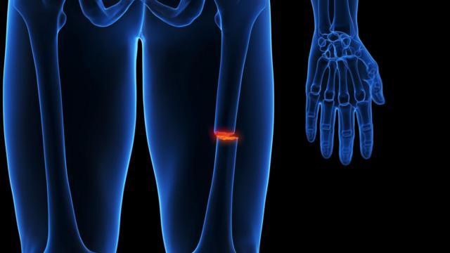 Radiografía de una fractura