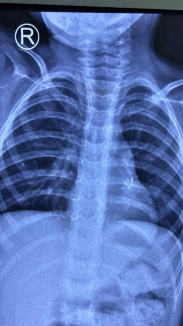 ਬੱਚਾ ਪਿਛਲੇ ਤਿੰਨ ਮਹੀਨਿਆਂ ਤੋਂ ਖੰਘ ਅਤੇ ਸਾਹ ਦੀ ਤਕਲੀਫ ਨਾਲ ਜੂਝ ਰਿਹਾ ਸੀ ਅਤੇ ਸਕੈਨ ਕਰਨ 'ਤੇ ਉਸਦੇ ਫੇਫੜੇ ਵਿੱਚ ਧਾਤੂ ਦਾ ਟੁਕੜਾ ਨਜ਼ਰ ਆਇਆ