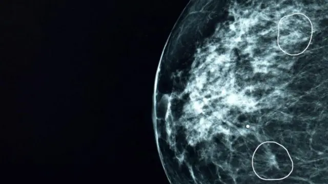 క్యాన్సర్ కణితి ఉన్న ప్రదేశం