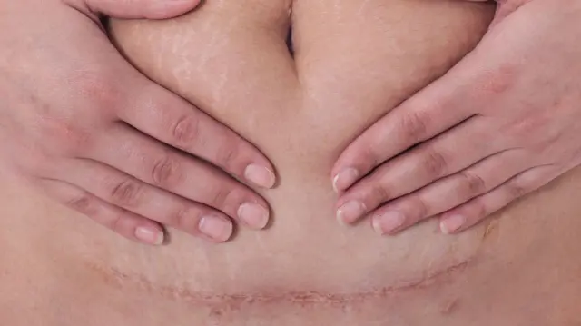 सिझेरियन प्रसूतीवेळेस दिलेल्या इंजेक्शनमुळे पुढे अनेक वर्षं पाठ दुखते का?