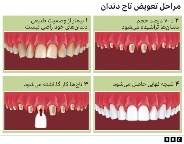 مراحل تعویض تاج دندان