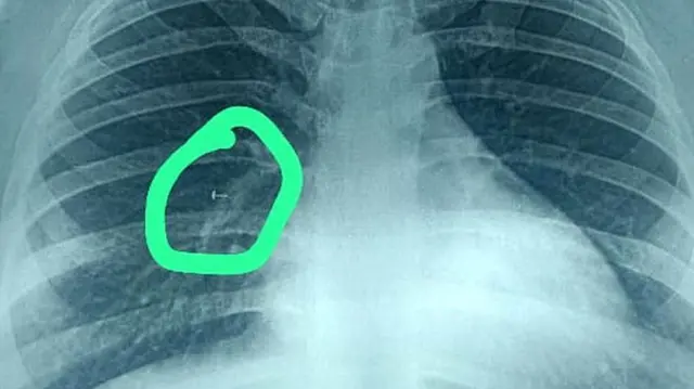 ఊపిరితిత్తుల్లో చిక్కుకున్న స్క్రూ ఫోటో 