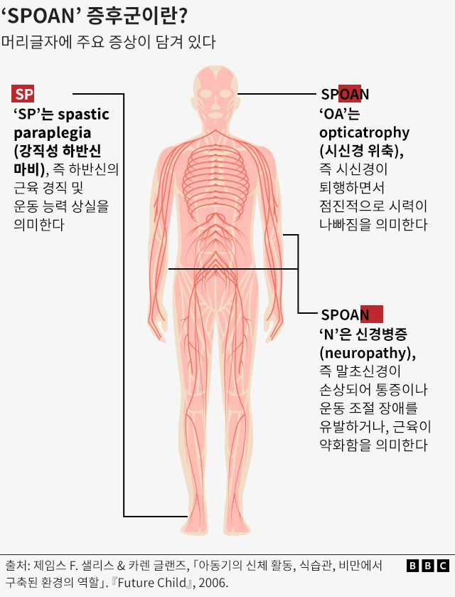 SPOAN 증후군의 주요 증상을 설명한 그래픽