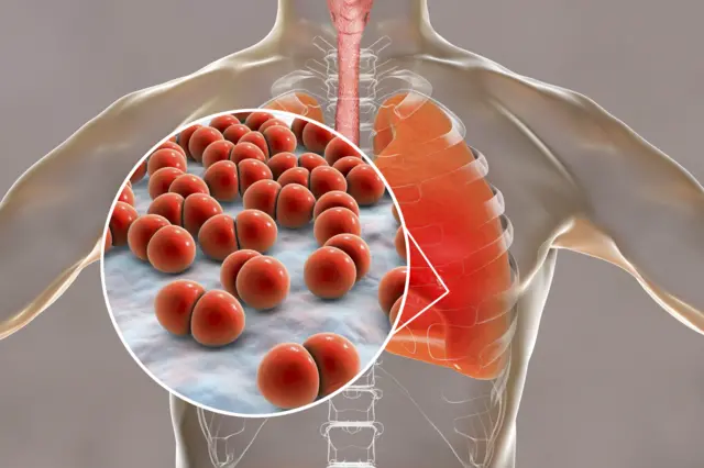  न्युमोकोकल